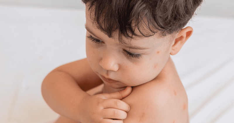 que-es-la-roseola-2